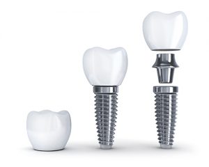 Dental Implants Pieces Diagram iStock 000077095183 Large 500px