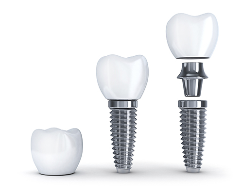 tooth-implant-disassembled