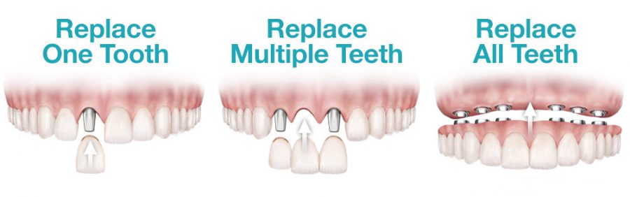 dental implant replacement options e1598188422293