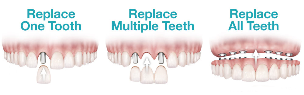 dental-implant-replacement-options