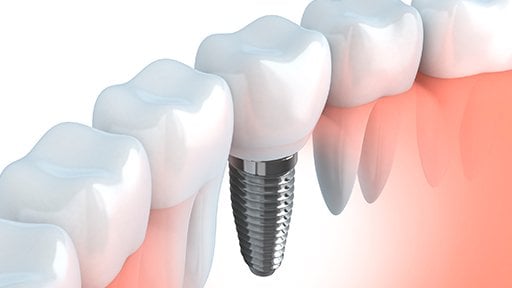 Dental Implant