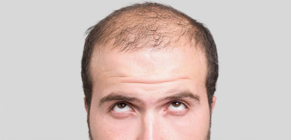 hair transplant