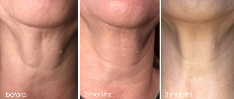 Microneedling