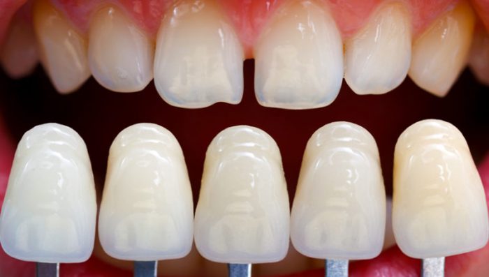 Cost of Dental Veneer 800x454 e1597224093500