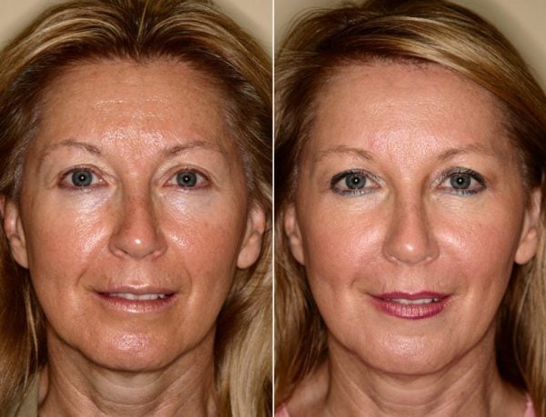 Face Mesotherapy