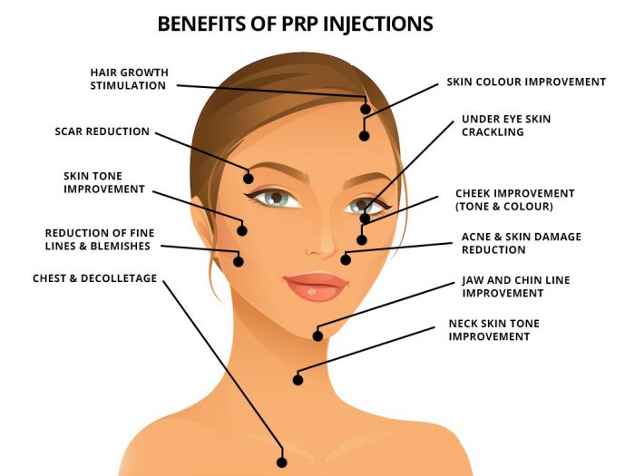 PRP injection