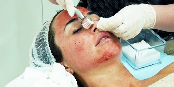 Microneedling