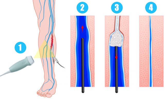 Sclerotherapy