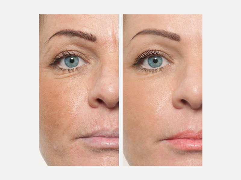 microneedling-2