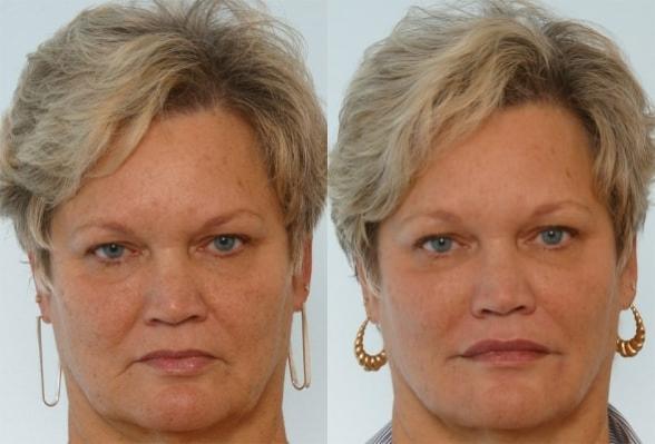 patient-29450-restylane-before-after-2