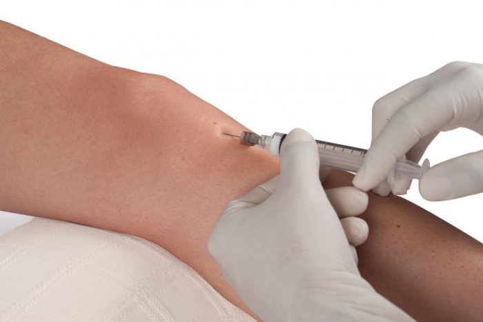 Sclerotherapy