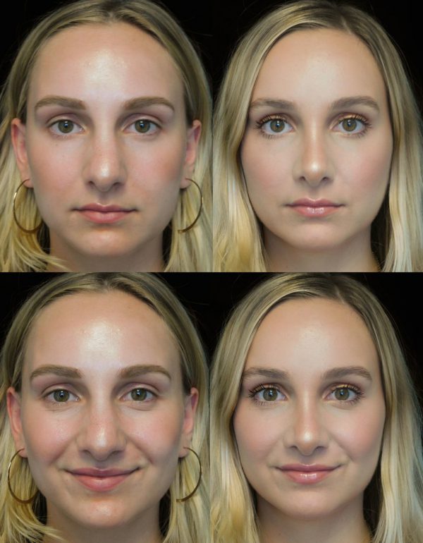 Rhinoplasty