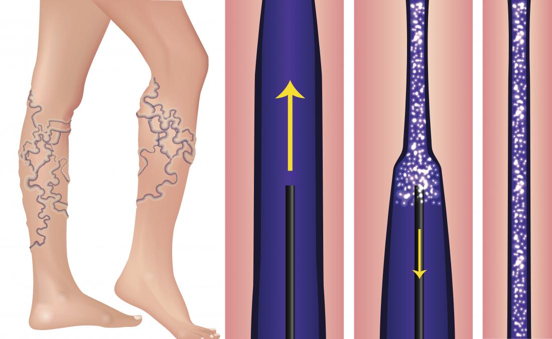 sclerotherapy