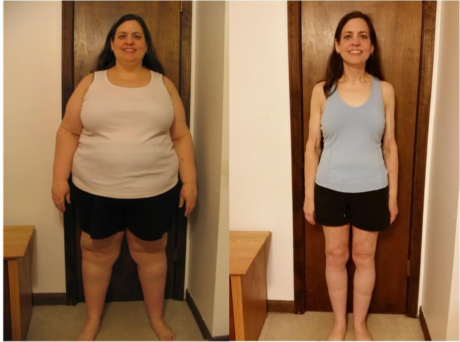 Sleeve Weight Loss Surgery Cost Gastric Sleeve Weight Loss Surgery In 