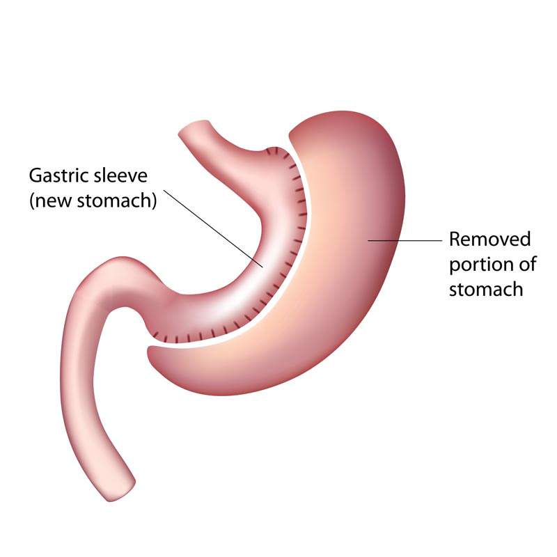 Gastric sleeve weight loss surgery