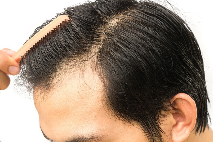 what makes you a good candidate for a hair transplant 1