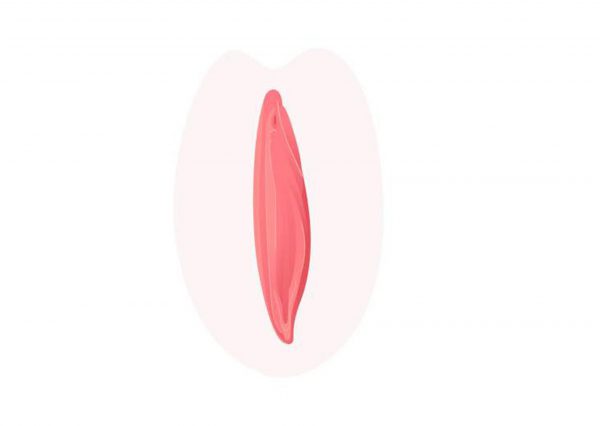 Labiaplasty