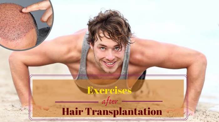 hair transplant and exercise