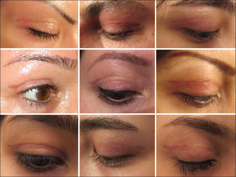 blepharoplasty-3