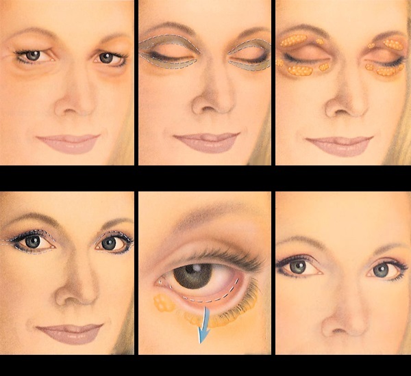 blepharoplasty