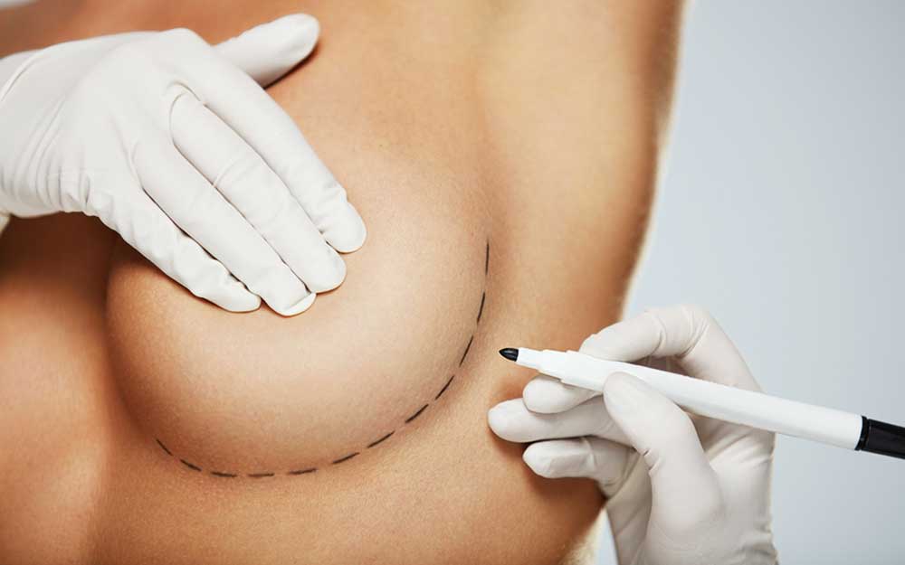 Breast lift , Breast Augmentation , Breast Prosthesis