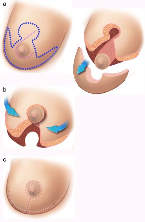 Breast Reduction Surgery Mammoplasty