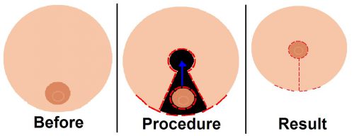 Breast Reduction Surgery Mammoplasty