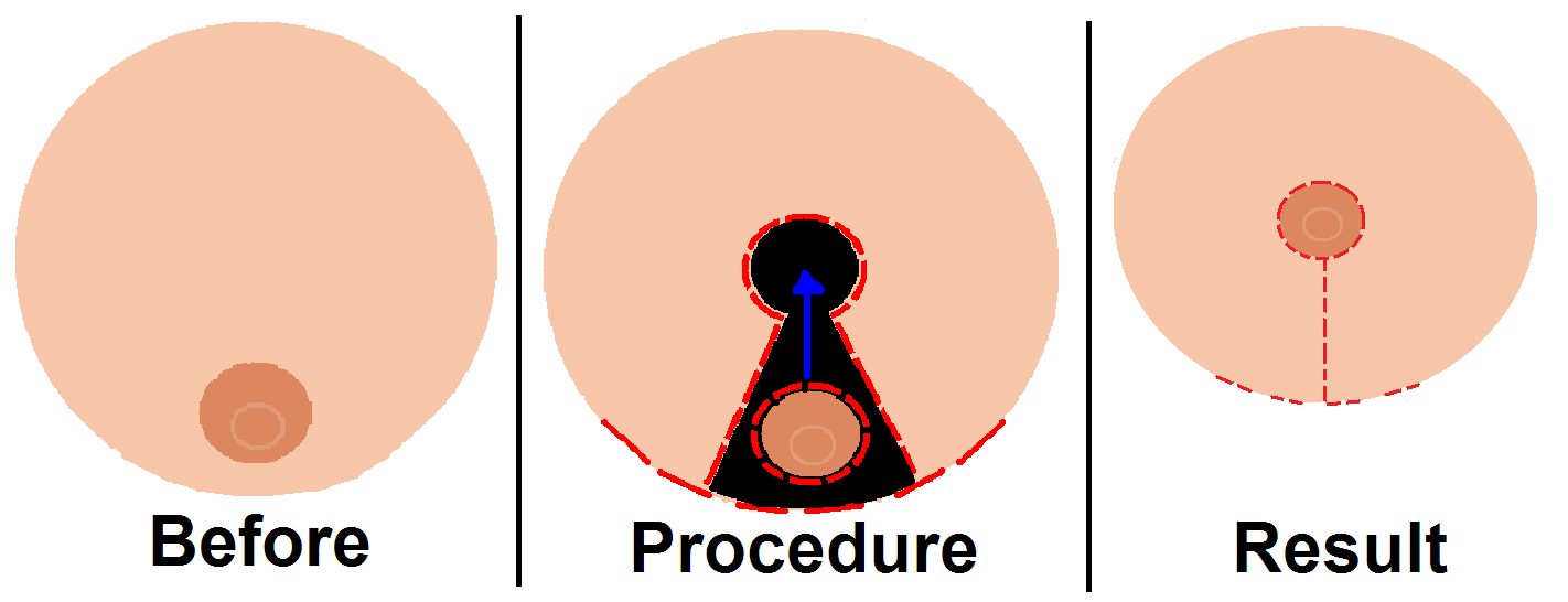 breast-reduction-surgery-mammoplasty-133