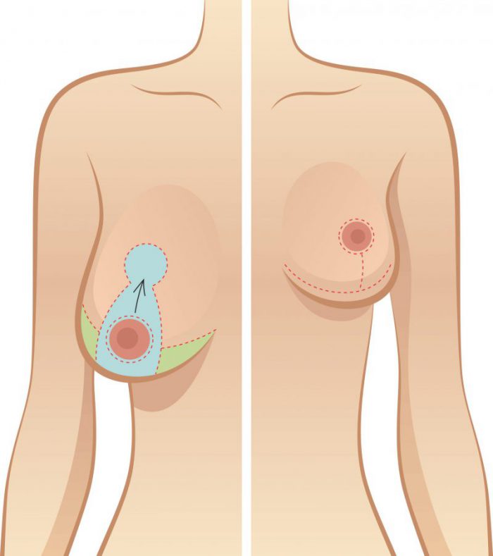 Breast Reduction Surgery Mammoplasty
