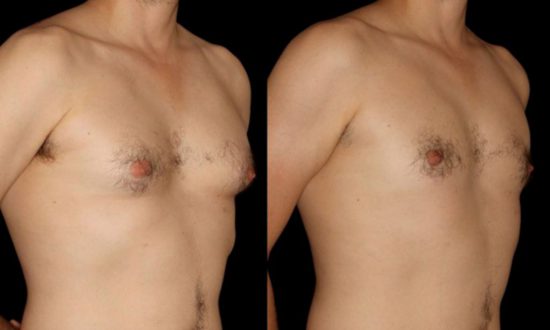 Breast Reduction Surgery Mammoplasty