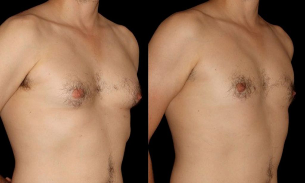 breast-reduction-surgery-mammoplasty-6