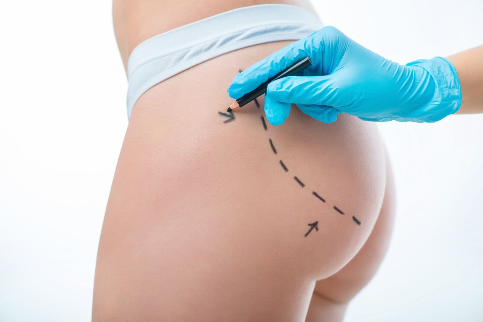 butt-lift-gluteoplasty-6