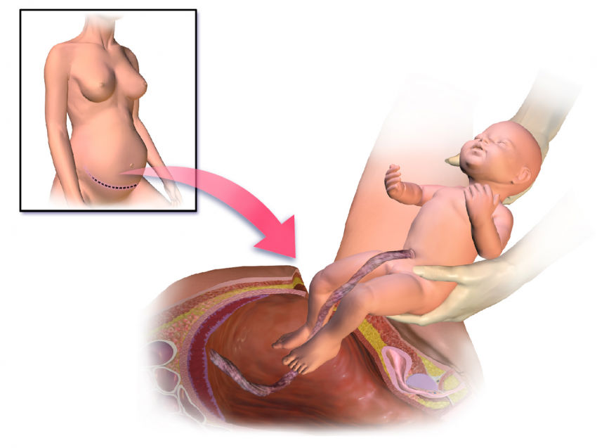 cesarean-section-110