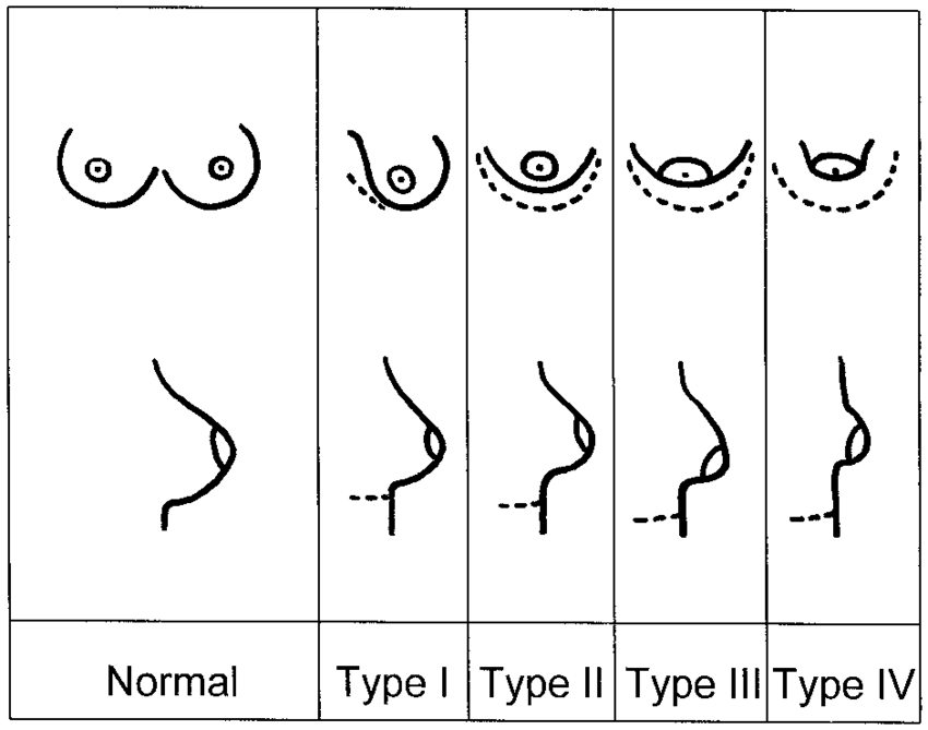 classification-of-the-tuberous-breast-deformity-the-higher-the-type-of-deformity-the