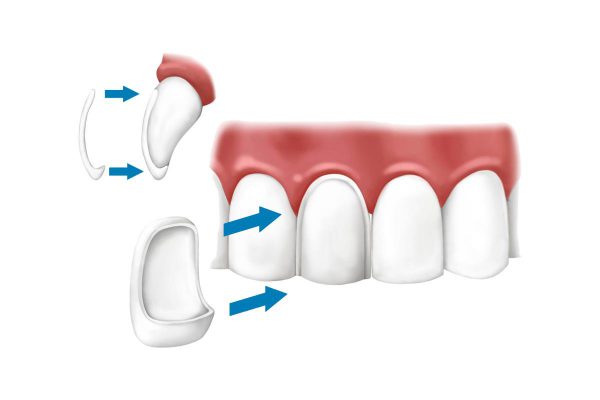 Dental Laminates Porcelain Veneer 2 e1598171932658