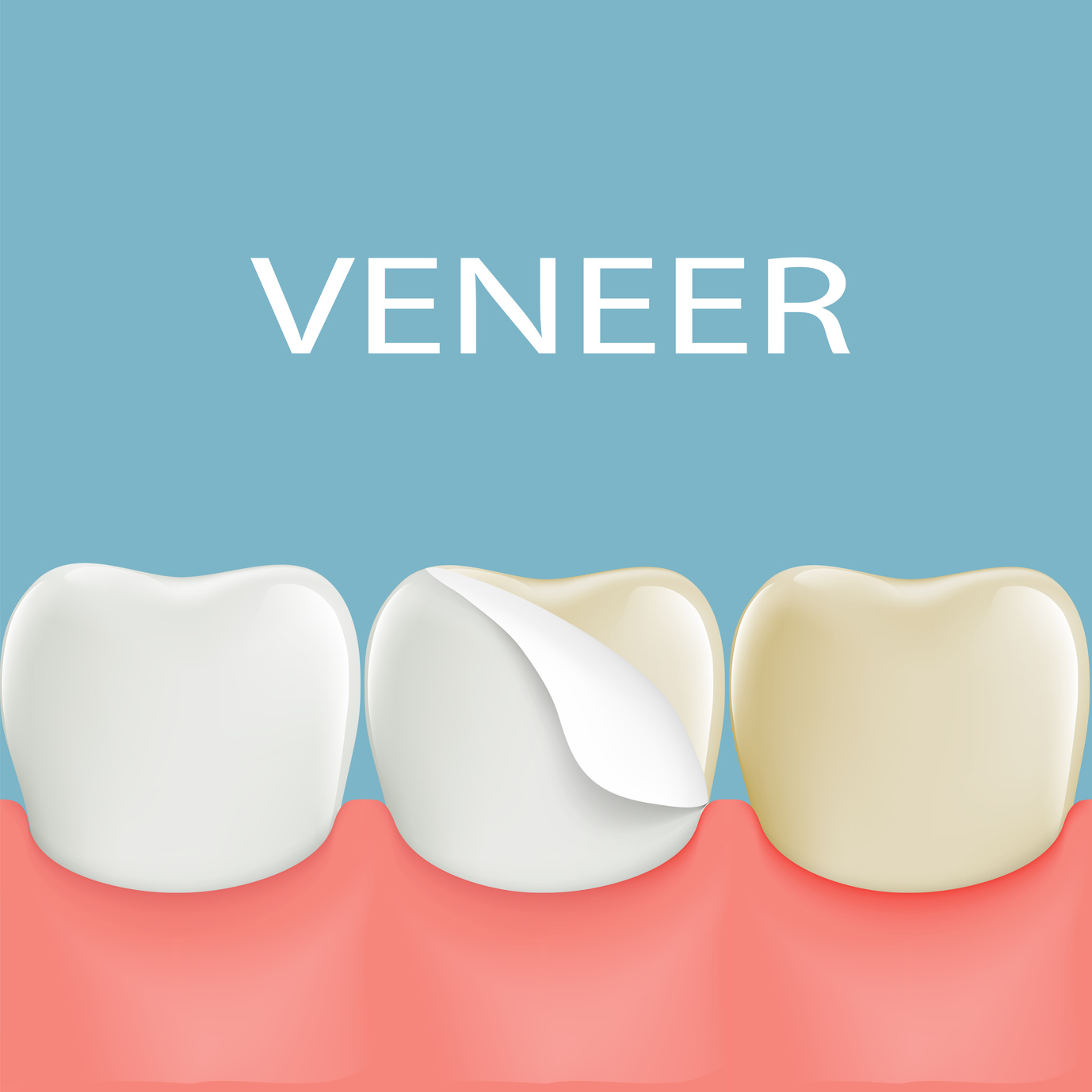 dental-veneers-on-a-human-tooth-stock-vector