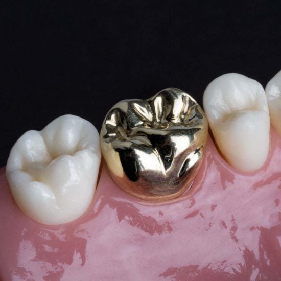 Dental Crowns