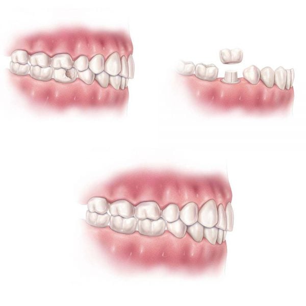 Dental Crowns