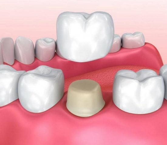 Dental Crowns