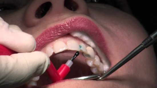 Dental filling Composite