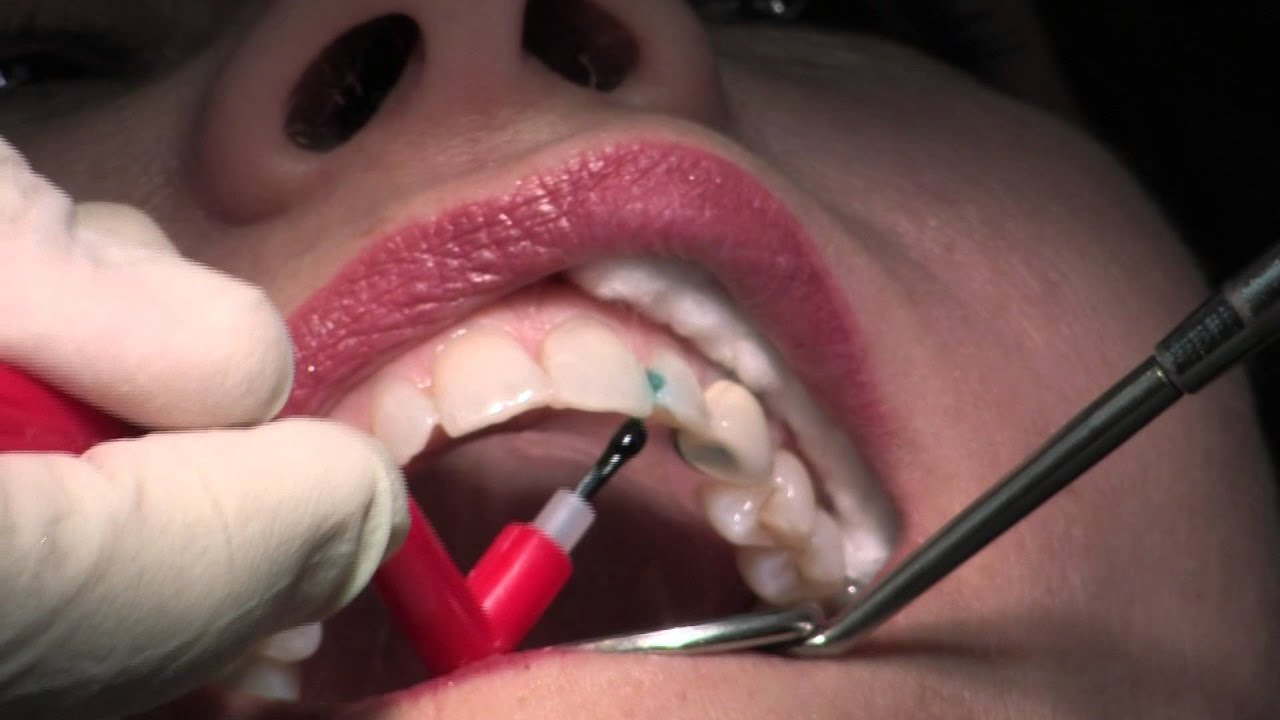 dental-filling-composite-7