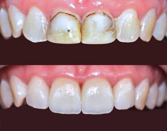 Dental filling Composite