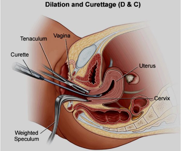 Dilation and curettage D & C cost