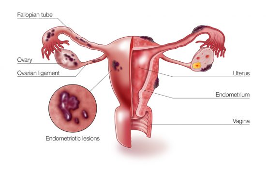 Endometriosis Microsurgery in Iran