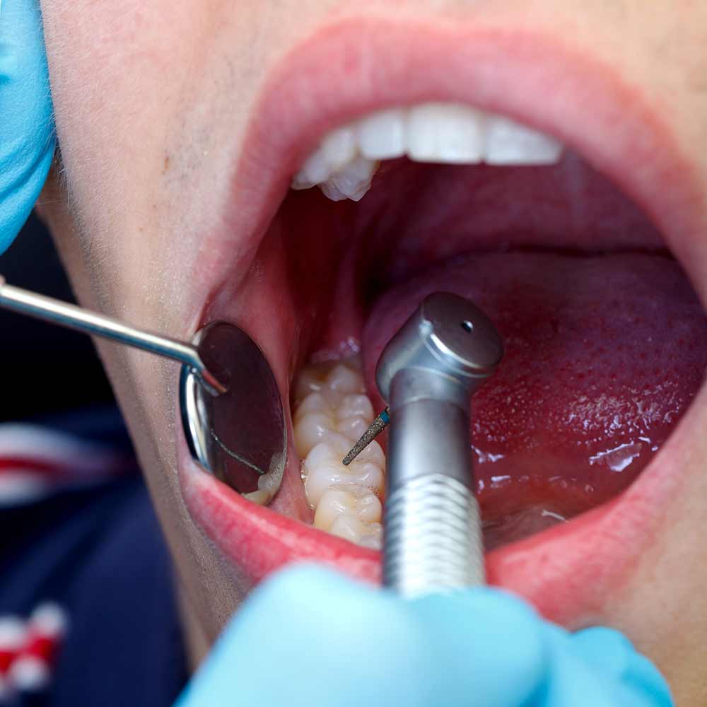 how-to-prepare-for-a-tooth-extraction