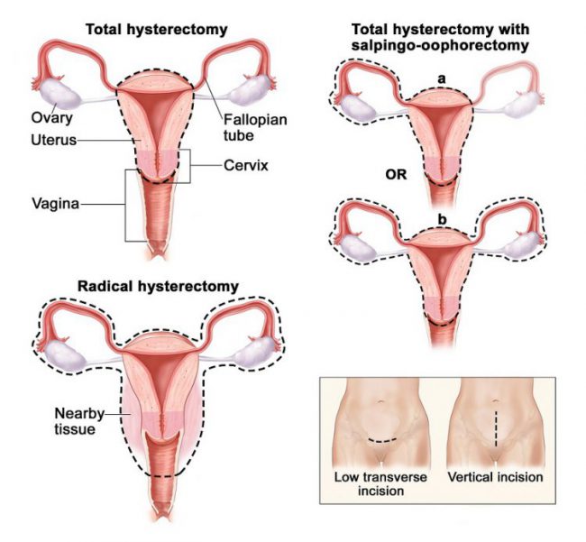 Hysterectomy