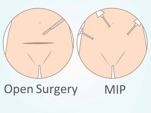 Hysterectomy