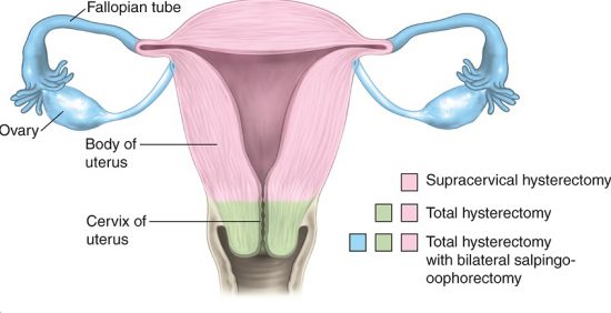 Hysterectomy