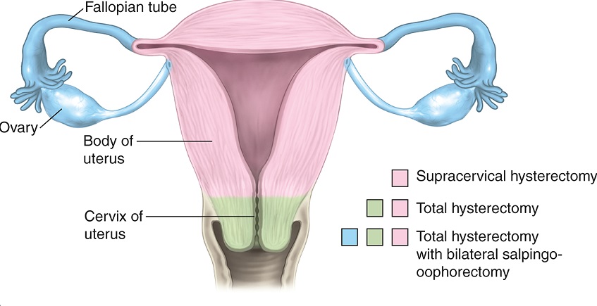 hysterectomy2