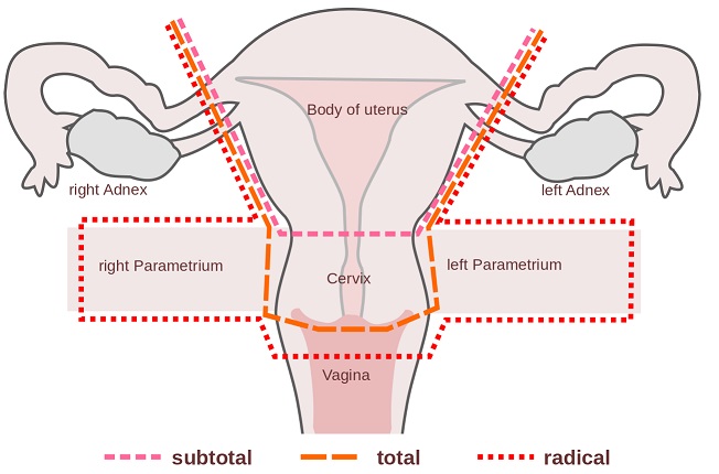 Hysterectomy